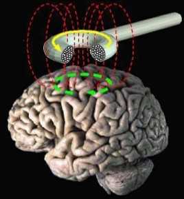 Migräneschmerzen: Magnetstimulation von FDA genehmigt